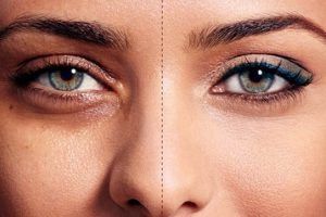 remedios para las ojeras