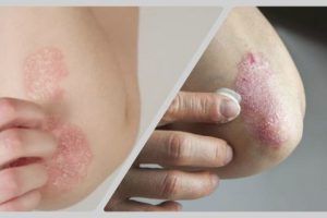 remedios caseros para la psoriasis