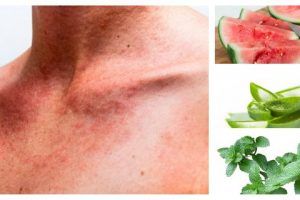 remedios caseros para el sarpullido de calor