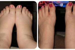 Remedios caseros para los tobillos hinchados