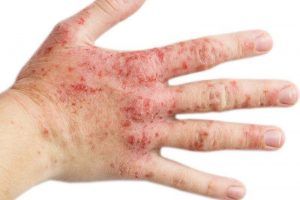 remedios para la dermatitis