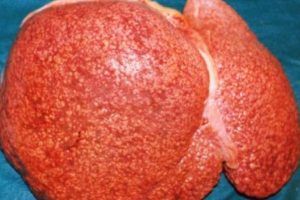 síntomas de la cirrosis