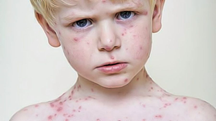 cuidados para la varicela