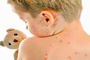 tratamientos para la varicela